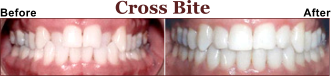 Have a Problem With a Cross Bite.