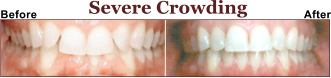 Is Your Teeth to Crowded? Let us Help You.