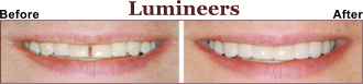 Lumineers - Could be the Answer for You.