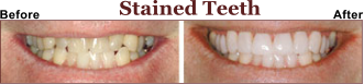Tired of Having Stained Teeth?  