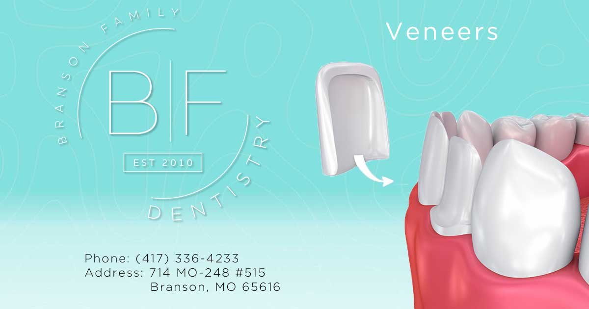 Dental Veneers at Branson Family Dentistry in Branson, MO.